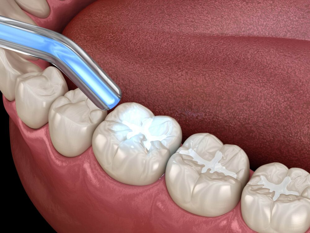 Dental fillings albany
