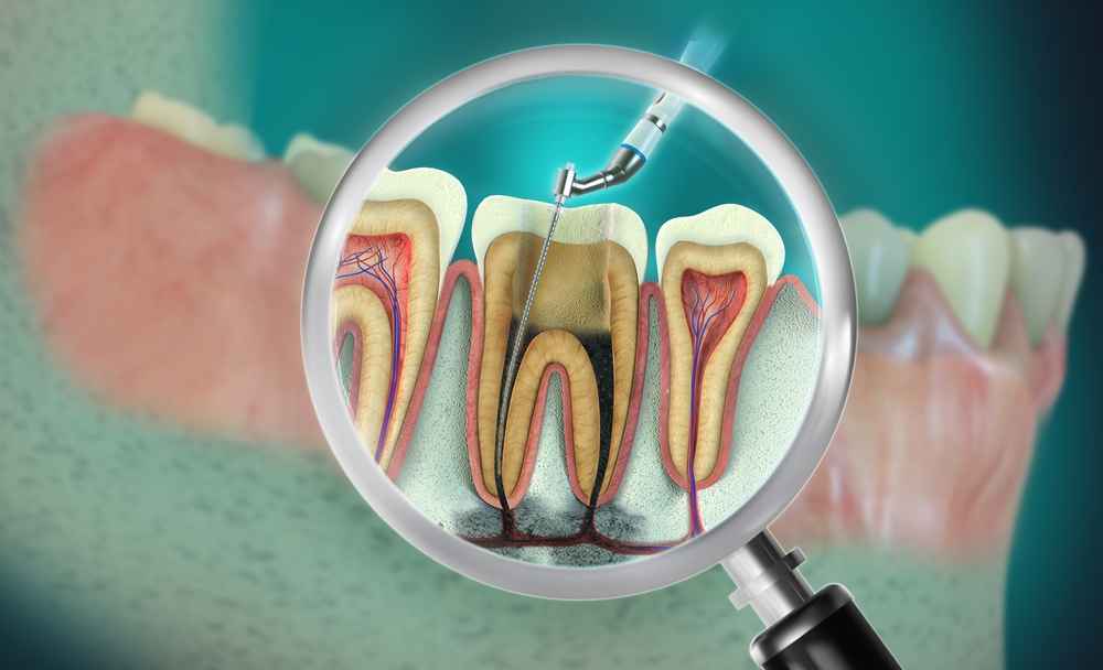 Root Canals albany